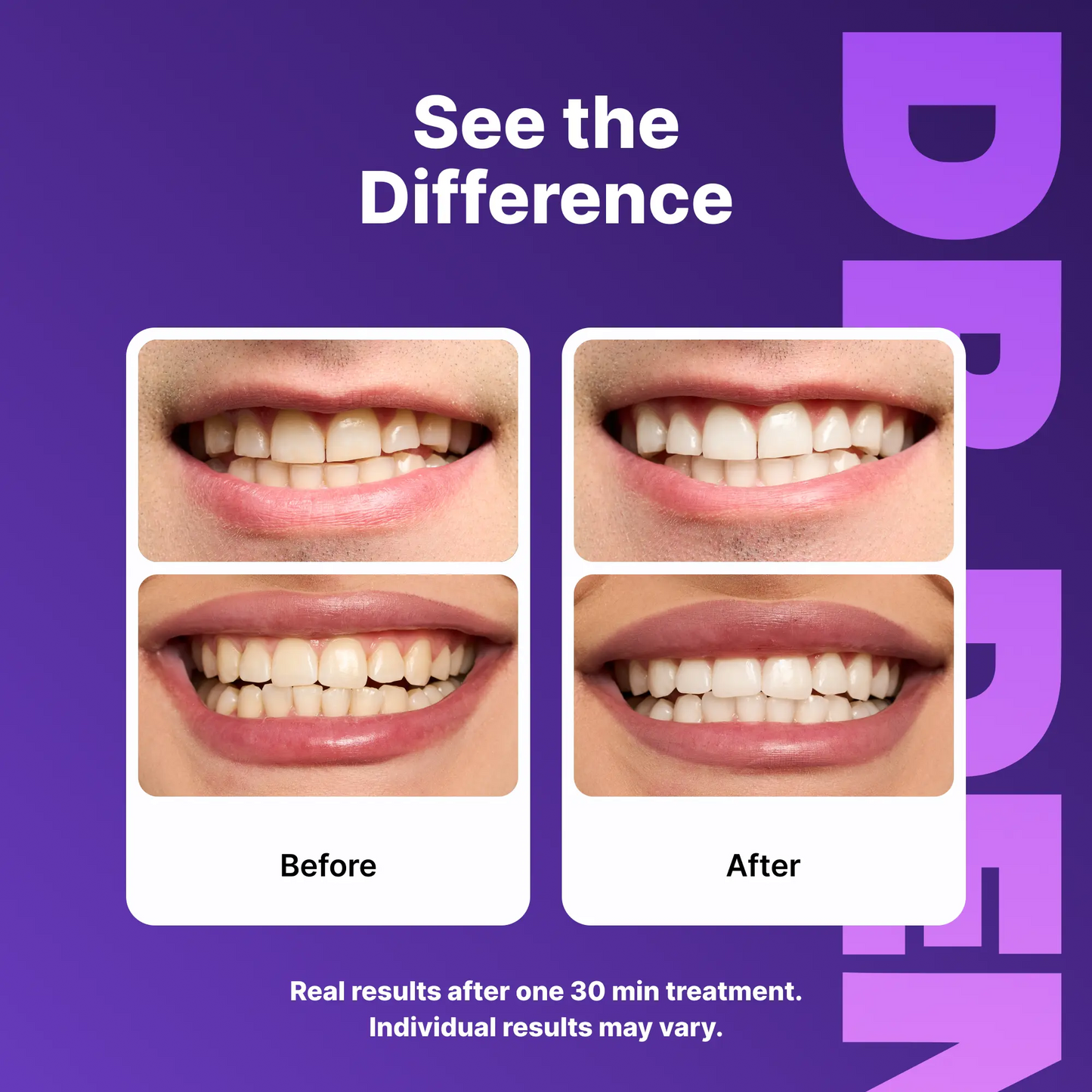 Enamel Veneers MAX Edition (42 veneers)