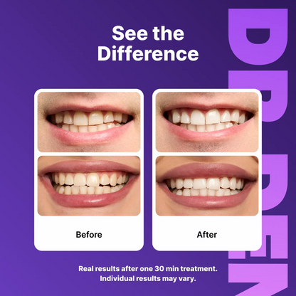 Enamel Veneers MAX Edition (42 veneers)